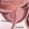 Tumore della prostata